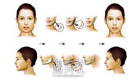 哈尔滨下颌角磨削多少钱?有哪些影响因素喃?