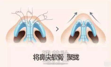 鼻翼宽大怎么办呢?鼻翼宽大有啥好的改良方法?