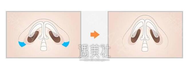 鼻翼宽大怎么办呢?鼻翼宽大有啥好的改良方法?