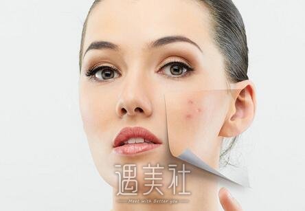 像素激光,调节痘疤痘坑,果好