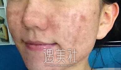 像素激光,调节痘疤痘坑,果好