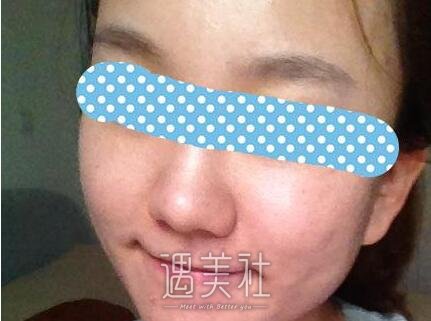 像素激光,调节痘疤痘坑,果好