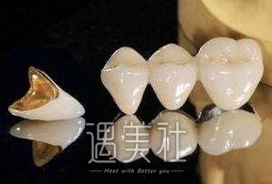 生物金属烤瓷牙一般可以用多少年?听俺慢慢分析~