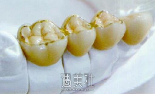 生物金属烤瓷牙一般可以用多少年?听俺慢慢分析~