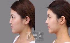 昆明伊维兰填充隆鼻多少钱?网路上是这样回答的~ width=