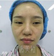 人造酒窝前后对比照片-人造酒窝真实案例分享~ width=