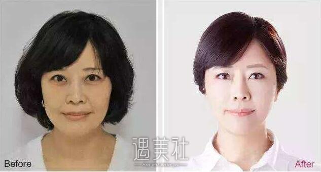 像束激光除皱是什么?像束激光除皱多方面了解下~