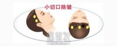 太原小切口除皱多少钱?市场价受啥因素影响喃? width=