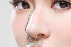 重庆驼峰鼻矫正价钱一般多少？一线城市都贵吗？ width=