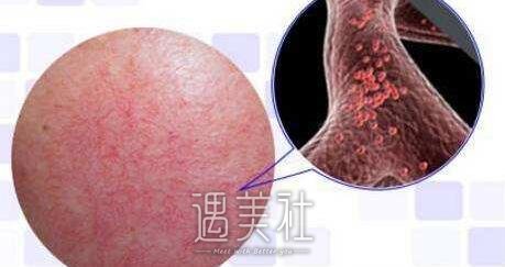 激光嫩肤有副作用吗?我二姨想做激光嫩肤!