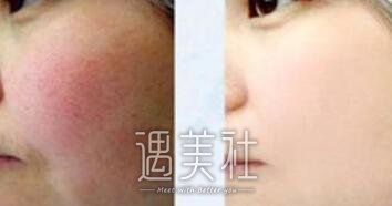 复合彩光,调节红血丝,果好吗,有哪些优势