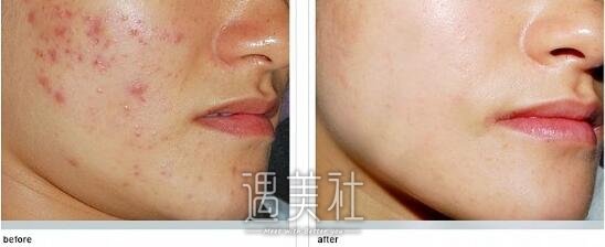 像素激光,祛痘印,有后遗症吗,如何避免