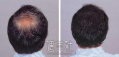 成都哪里做毛发种植好?有植发专科机构吗? width=