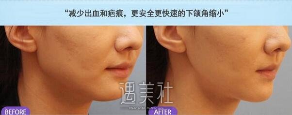 肥胖下颌角整容