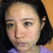 果酸换肤对比图分享——来自果酸换肤案例~ width=