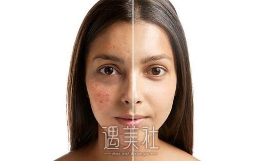 飞顿光子嫩肤有副作用吗|飞顿光子嫩肤副作用盘点~
