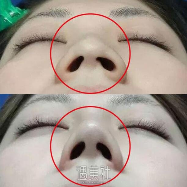 鼻翼改薄整形医院做好还是公办医院好?在线等!