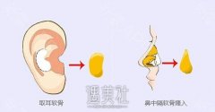 北京耳软骨隆鼻尖费用大概多少钱?我姐让我问下! width=