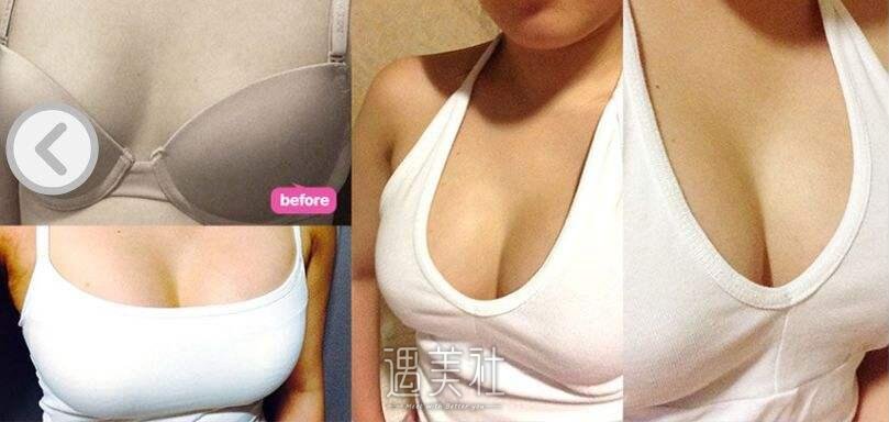 广州伊丽莎白刘云忠做丰胸怎么样?乃丰胸典范!