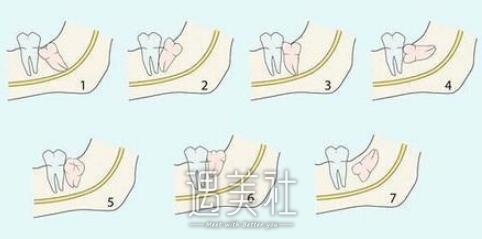 拔智齿后吃什么比较好?拔智齿后不能哪些食物呢?