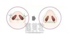 太原鼻尖肥大整形多少钱?想要个精致的鼻尖! width=