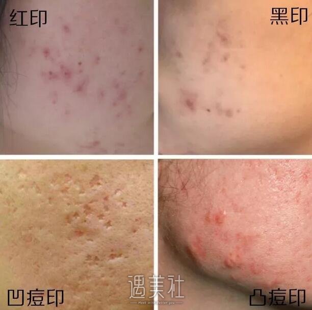 像素激光痘疤