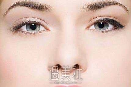 膨体隆鼻