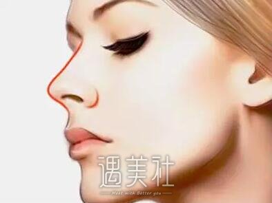 膨体隆鼻