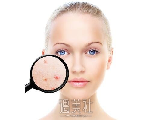 像素激光去痘疤做一次有吗?需要做多次吗?