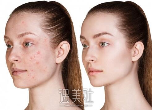 像素激光去痘疤做一次有吗?需要做多次吗?