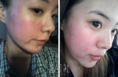 果酸换肤果图——来自果酸换肤真实案例一条~ width=