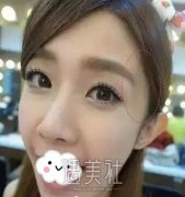 清远华康医院打了两针玻尿酸，脸上饱满多了喃？ width=