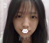 李芳整形做了全切双眼皮，让我告别“眯眯眼” width=