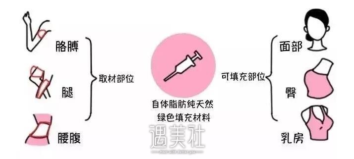 面部填充手术方法