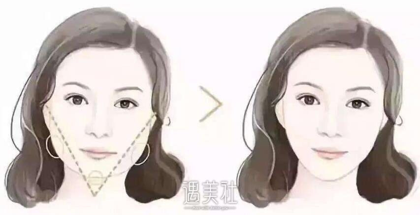 西安注射瘦脸