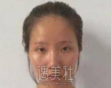自体脂肪移植丰脸颊的果怎么样？先看这案例！ width=