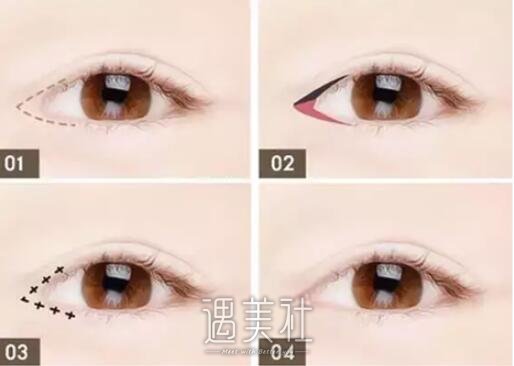 不适合开眼角眼型图片|哪些眼型不适合开眼角呢?