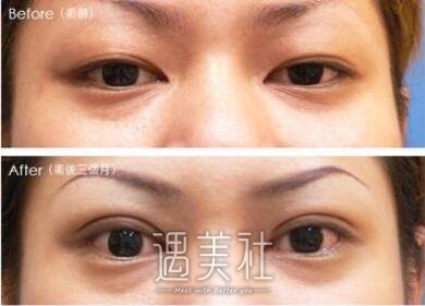 上眼皮吸脂果好吗?上眼皮吸脂有可能反弹吗?