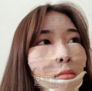 北京美联臣医院做了面部填充，脸终于饱满多了~ width=