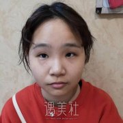 延世整形医院金奇龙做双眼皮怎么样?案例来证明! width=