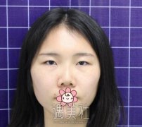 汕头名流整形医院做了双眼皮：闺蜜们都想去做个呢！ width=
