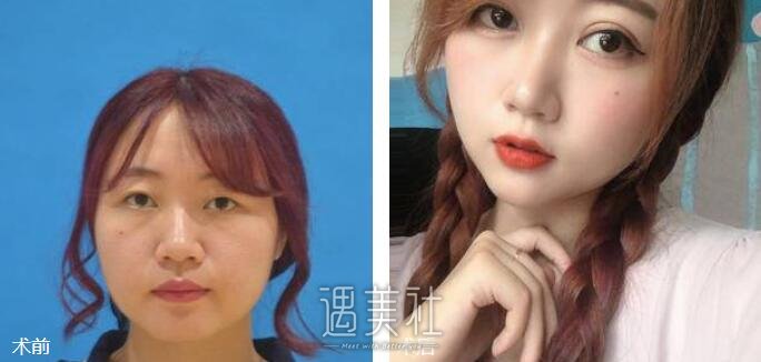 双眼皮全切图片