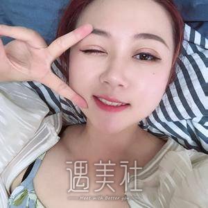 双眼皮全切图片
