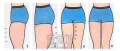 中山吸脂瘦大腿大约多少钱?广东的朋友帮忙回答下! width=