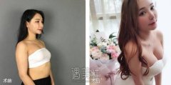 西安美立方整形美容医院假体丰胸真实案例给你看~ width=
