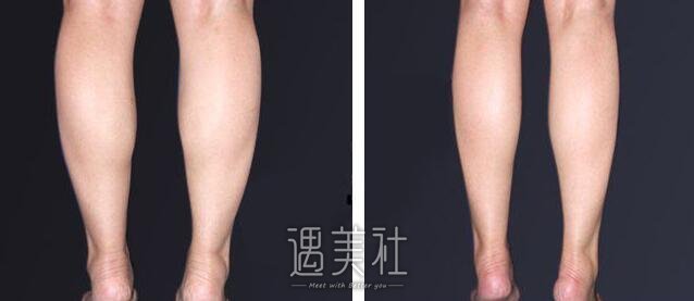 光纤溶脂瘦小腿