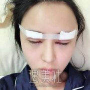 李斌斌修复双眼皮案例分享：“大眼美女”从此成为我的标签！ width=