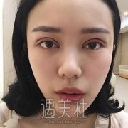 煤炭医院整形李敏双眼皮案例一则，告别昔日眯眯眼~ width=
