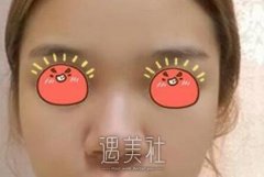 蒜头鼻整形对比照片分享——来自蒜头鼻整形案例~ width=