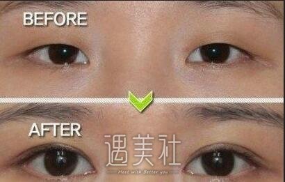 埋线双眼皮